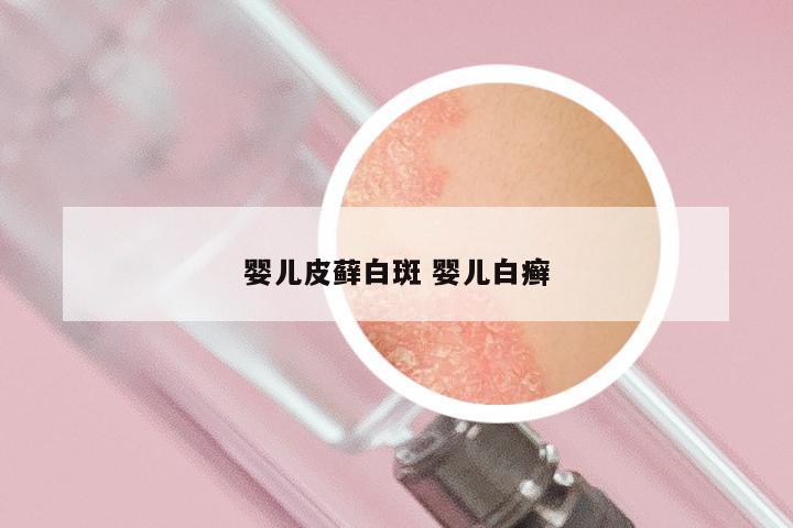 婴儿皮藓白斑 婴儿白癣