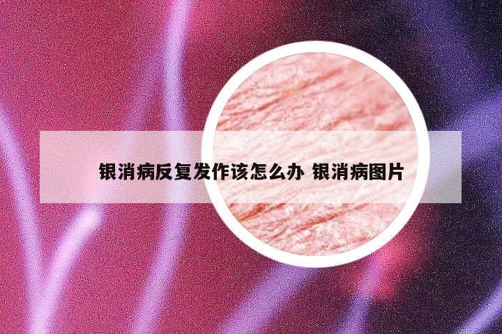 银消病反复发作该怎么办 银消病图片