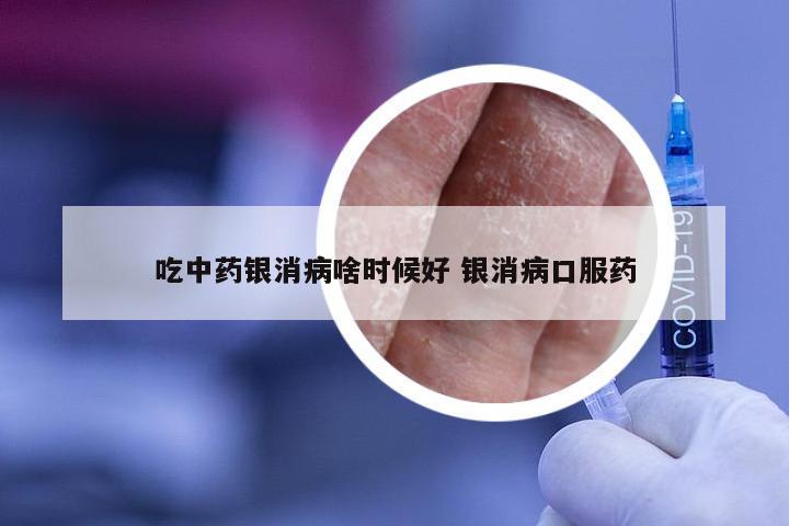 吃中药银消病啥时候好 银消病口服药