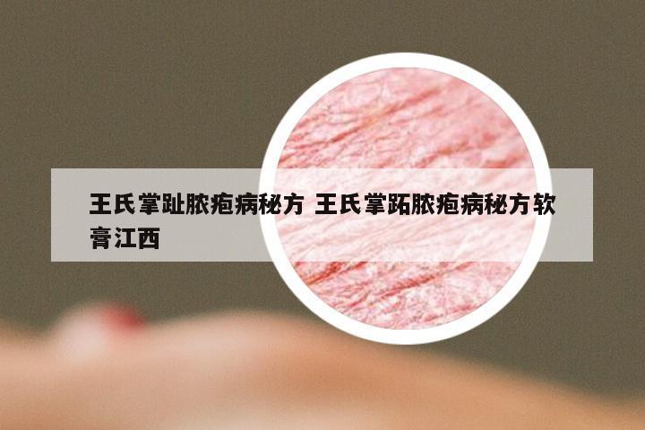 王氏掌趾脓疱病秘方 王氏掌跖脓疱病秘方软膏江西