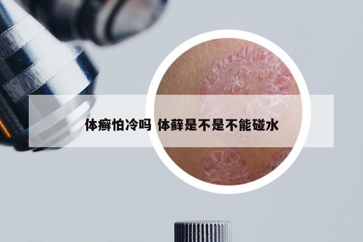 体癣怕冷吗 体藓是不是不能碰水