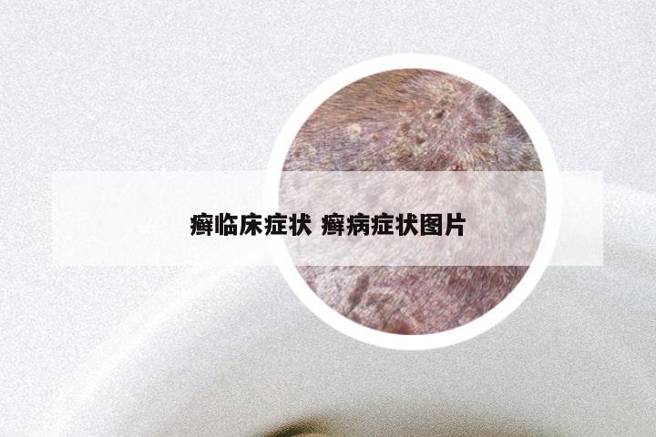 癣临床症状 癣病症状图片