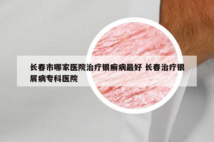 长春市哪家医院治疗银癣病最好 长春治疗银屑病专科医院