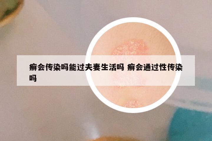 癣会传染吗能过夫妻生活吗 癣会通过性传染吗