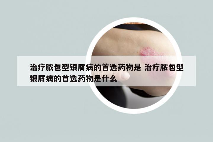 治疗脓包型银屑病的首选药物是 治疗脓包型银屑病的首选药物是什么