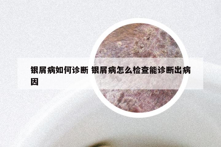 银屑病如何诊断 银屑病怎么检查能诊断出病因