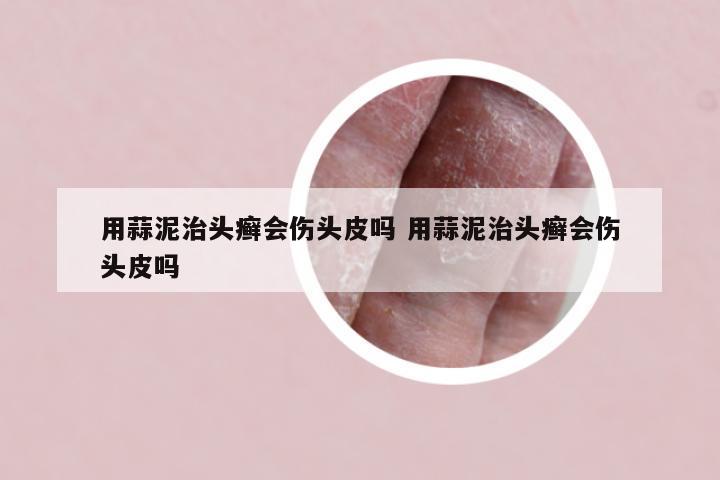 用蒜泥治头癣会伤头皮吗 用蒜泥治头癣会伤头皮吗