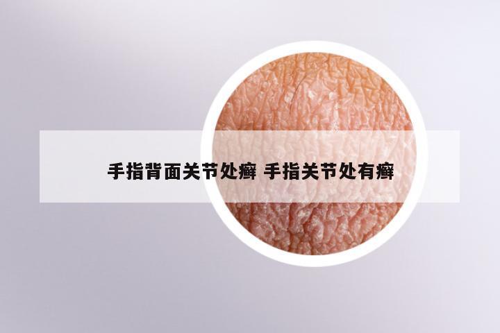 手指背面关节处癣 手指关节处有癣