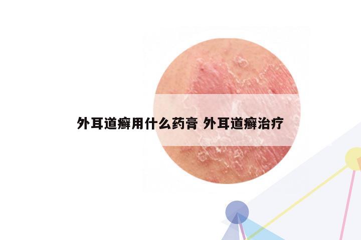 外耳道癣用什么药膏 外耳道癣治疗