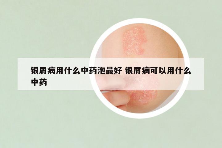 银屑病用什么中药泡最好 银屑病可以用什么中药