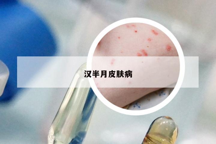 汉半月皮肤病
