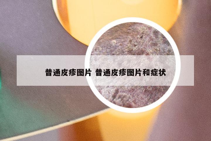 普通皮疹图片 普通皮疹图片和症状