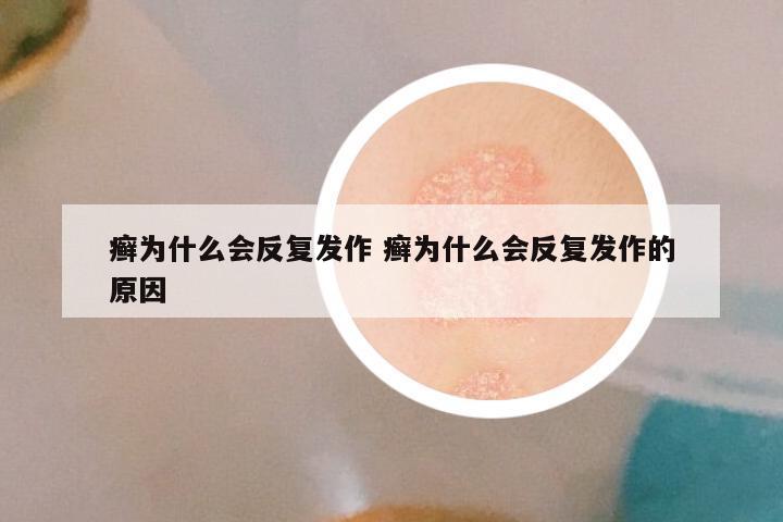 癣为什么会反复发作 癣为什么会反复发作的原因