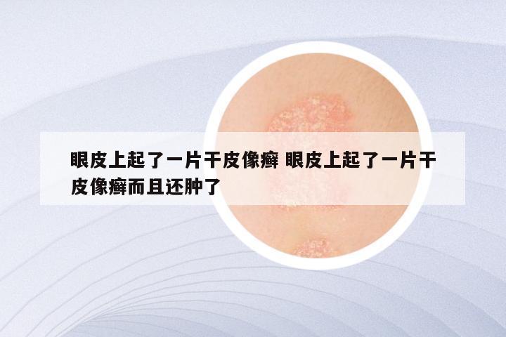 眼皮上起了一片干皮像癣 眼皮上起了一片干皮像癣而且还肿了