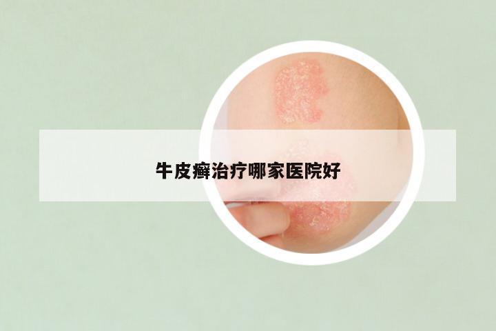 牛皮癣治疗哪家医院好