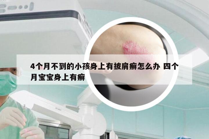 4个月不到的小孩身上有披肩癣怎么办 四个月宝宝身上有癣