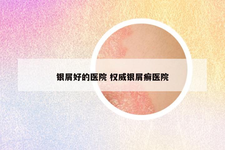 银屑好的医院 权威银屑癣医院