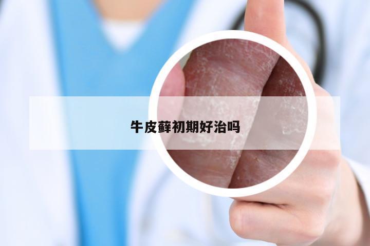 牛皮藓初期好治吗