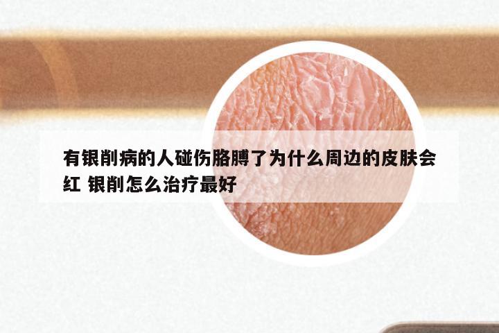 有银削病的人碰伤胳膊了为什么周边的皮肤会红 银削怎么治疗最好
