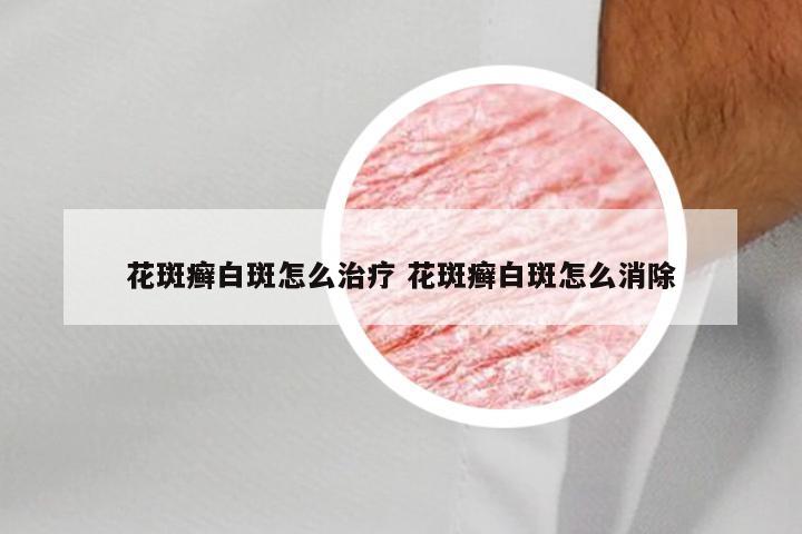 花斑癣白斑怎么治疗 花斑癣白斑怎么消除