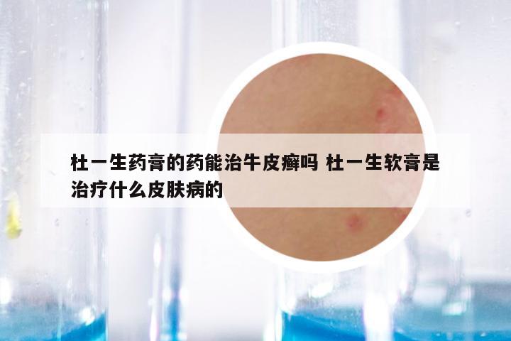 杜一生药膏的药能治牛皮癣吗 杜一生软膏是治疗什么皮肤病的