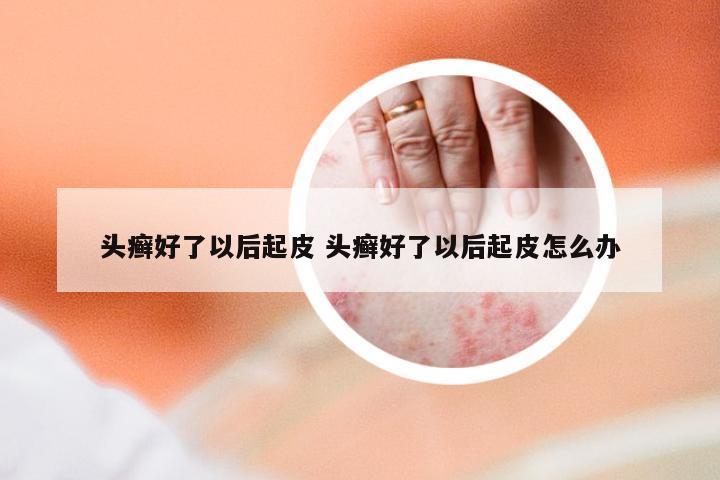 头癣好了以后起皮 头癣好了以后起皮怎么办