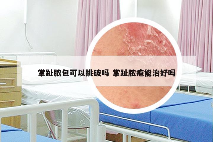 掌趾脓包可以挑破吗 掌趾脓疱能治好吗