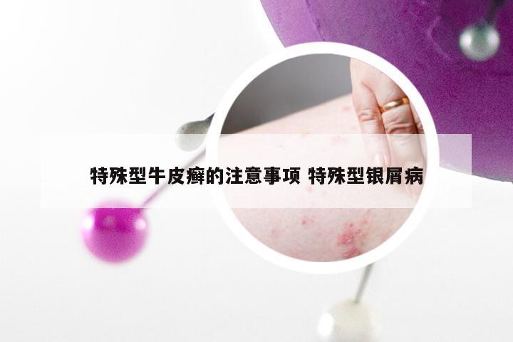 特殊型牛皮癣的注意事项 特殊型银屑病