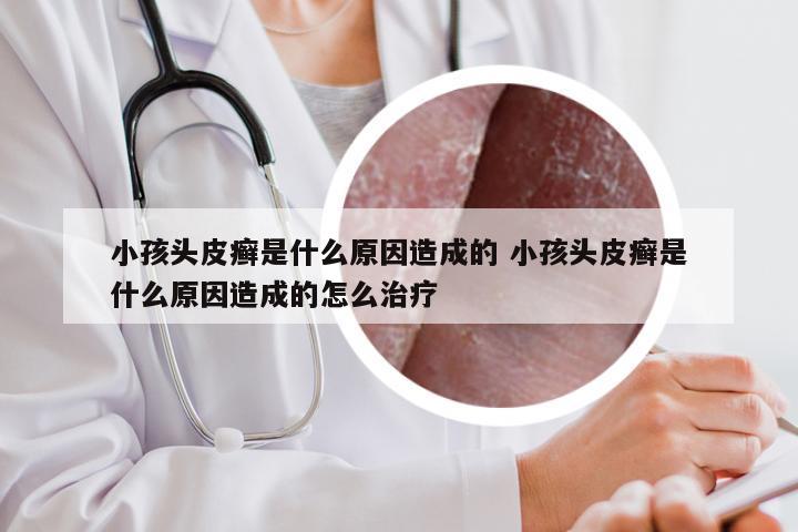 小孩头皮癣是什么原因造成的 小孩头皮癣是什么原因造成的怎么治疗