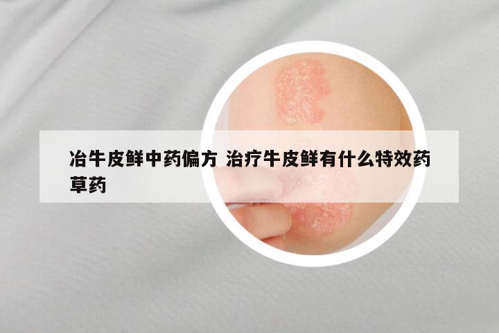 冶牛皮鲜中药偏方 治疗牛皮鲜有什么特效药草药