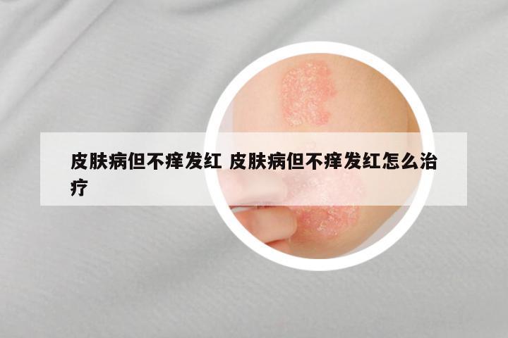 皮肤病但不痒发红 皮肤病但不痒发红怎么治疗