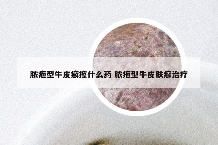 脓疱型牛皮癣擦什么药 脓疱型牛皮肤癣治疗