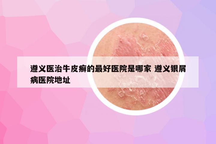 遵义医治牛皮癣的最好医院是哪家 遵义银屑病医院地址