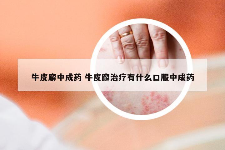 牛皮廨中成药 牛皮廨治疗有什么口服中成药