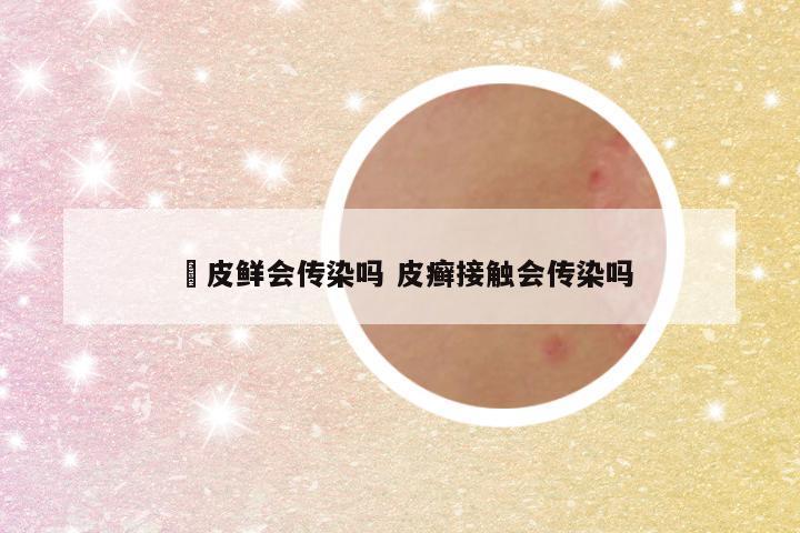 牜皮鲜会传染吗 皮癣接触会传染吗