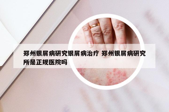 郑州银屑病研究银屑病治疗 郑州银屑病研究所是正规医院吗