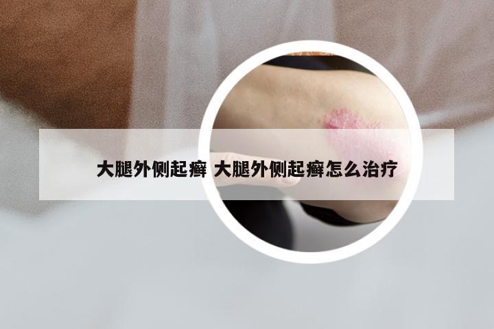 大腿外侧起癣 大腿外侧起癣怎么治疗