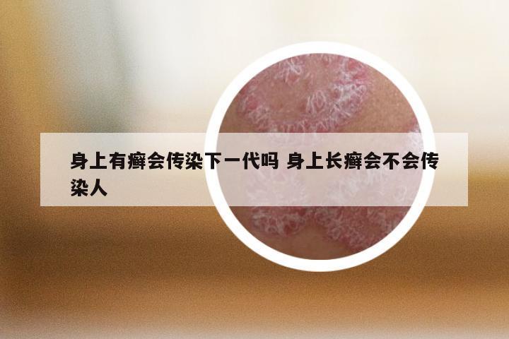 身上有癣会传染下一代吗 身上长癣会不会传染人