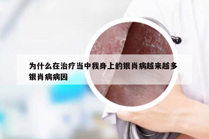 为什么在治疗当中我身上的银肖病越来越多 银肖病病因