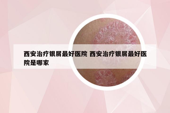 西安治疗银屑最好医院 西安治疗银屑最好医院是哪家