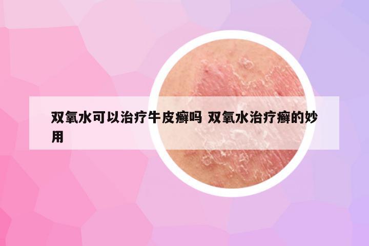 双氧水可以治疗牛皮癣吗 双氧水治疗癣的妙用