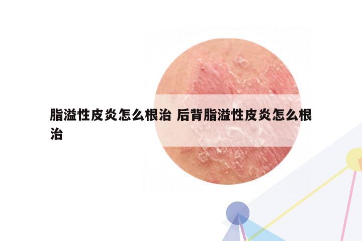 脂溢性皮炎怎么根治 后背脂溢性皮炎怎么根治
