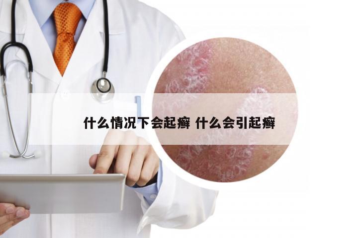 什么情况下会起癣 什么会引起癣