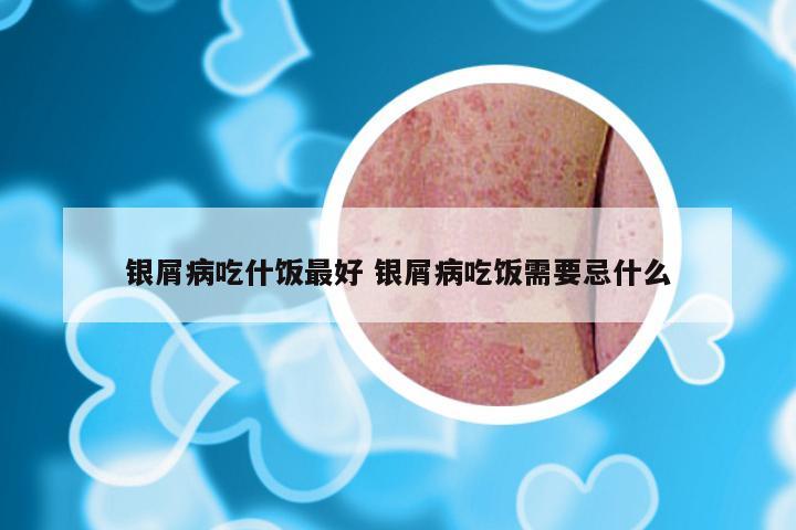 银屑病吃什饭最好 银屑病吃饭需要忌什么
