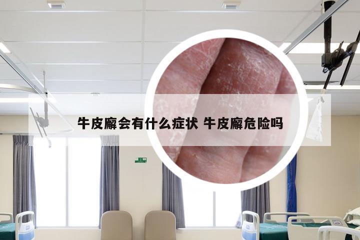 牛皮廨会有什么症状 牛皮廨危险吗