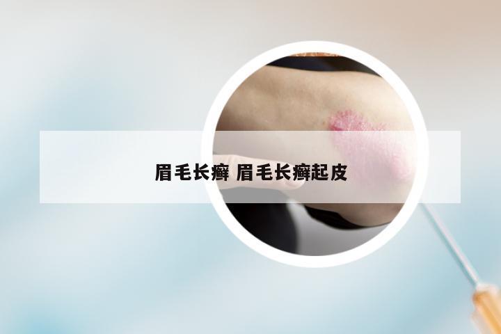 眉毛长癣 眉毛长癣起皮