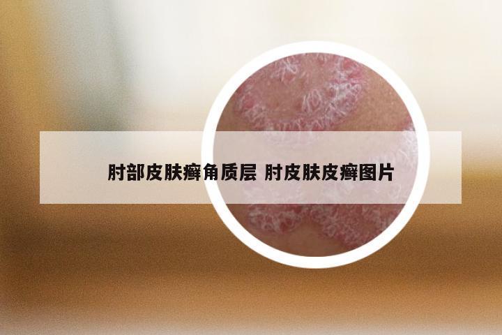 肘部皮肤癣角质层 肘皮肤皮癣图片