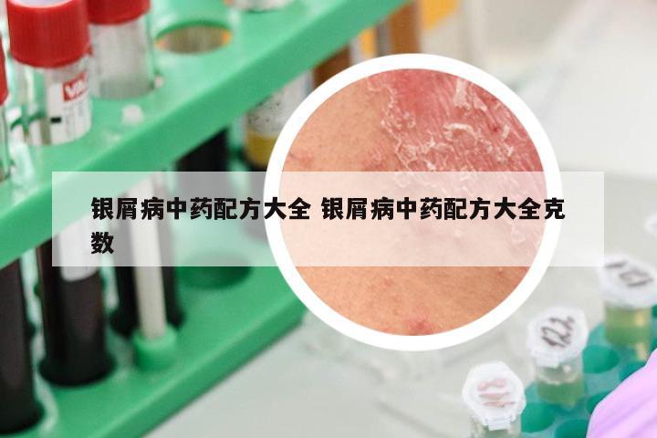 银屑病中药配方大全 银屑病中药配方大全克数