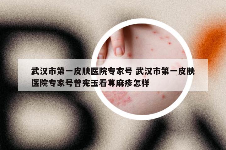 武汉市第一皮肤医院专家号 武汉市第一皮肤医院专家号曾宪玉看荨麻疹怎样