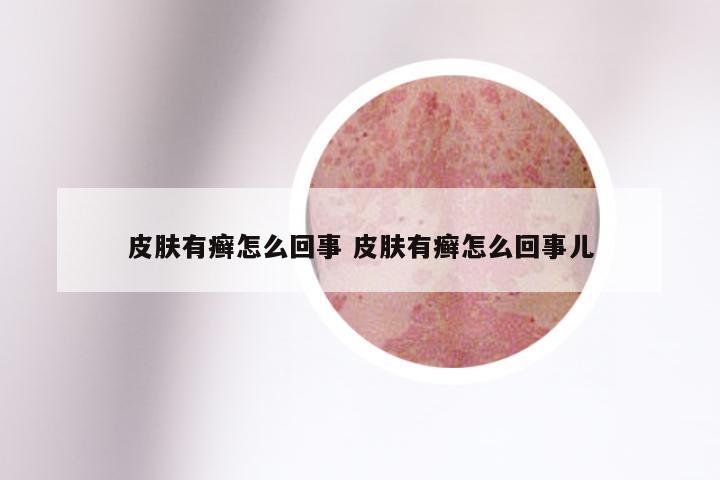 皮肤有癣怎么回事 皮肤有癣怎么回事儿